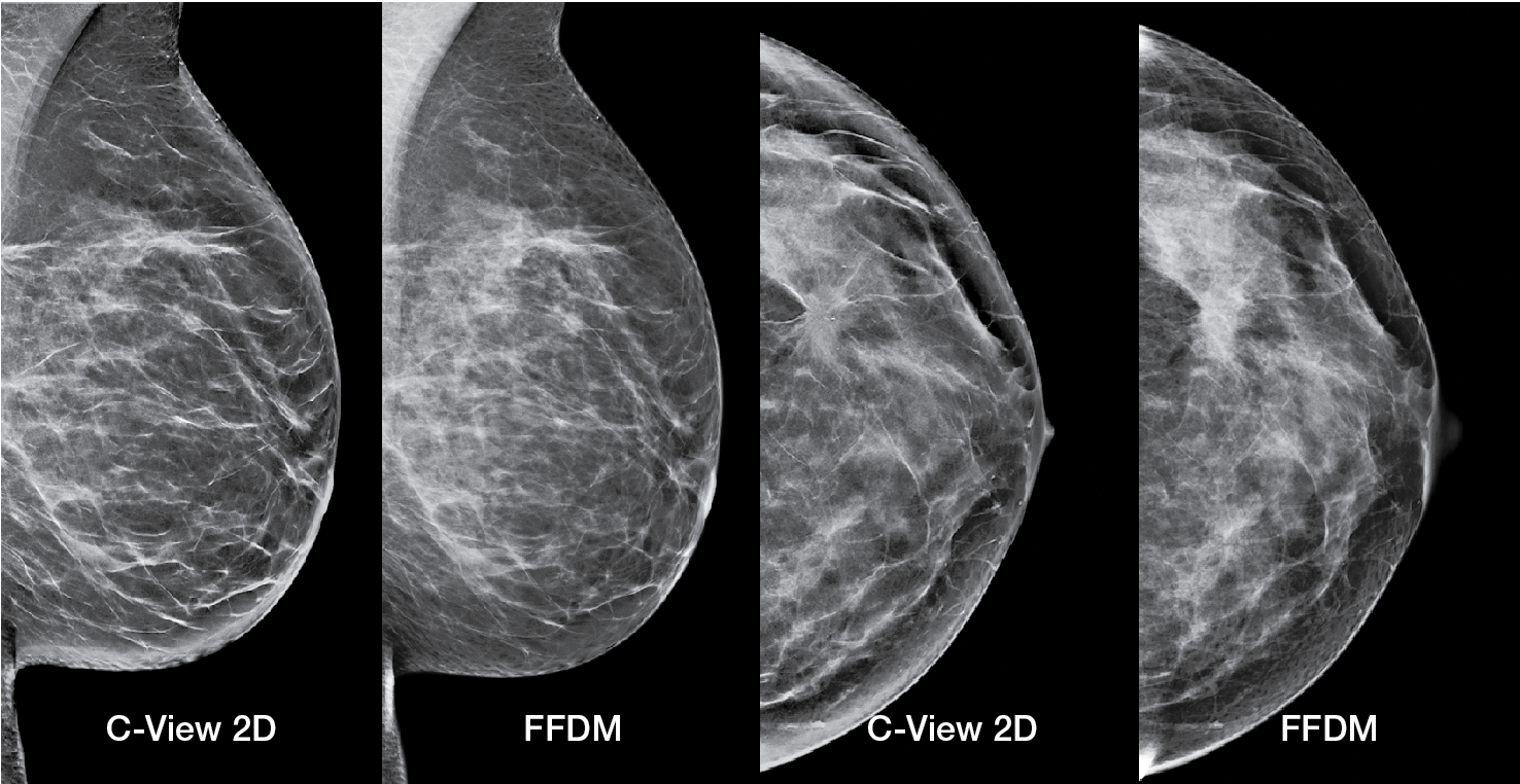 Reveal more with low-dose, highly accurate 3D Mammography™ exams